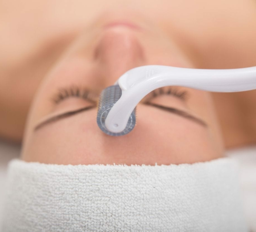 Microneedling